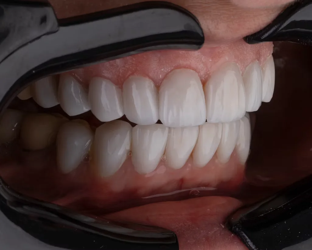 Close-up dental image representing cosmetic dentistry and smile enhancement in Flower Mound, TX