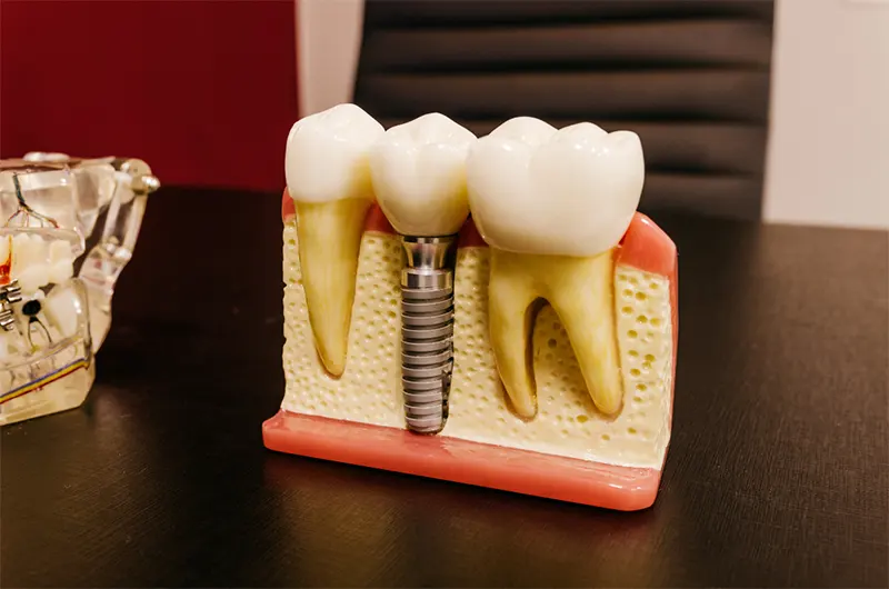 Dental implant model showing an implant post supporting a replacement tooth between natural teeth