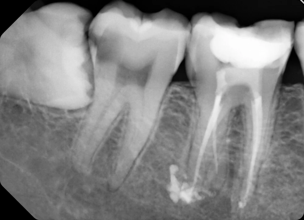 Female dental professional discussing options to save a natural tooth with a patient in Flower Mound, TX